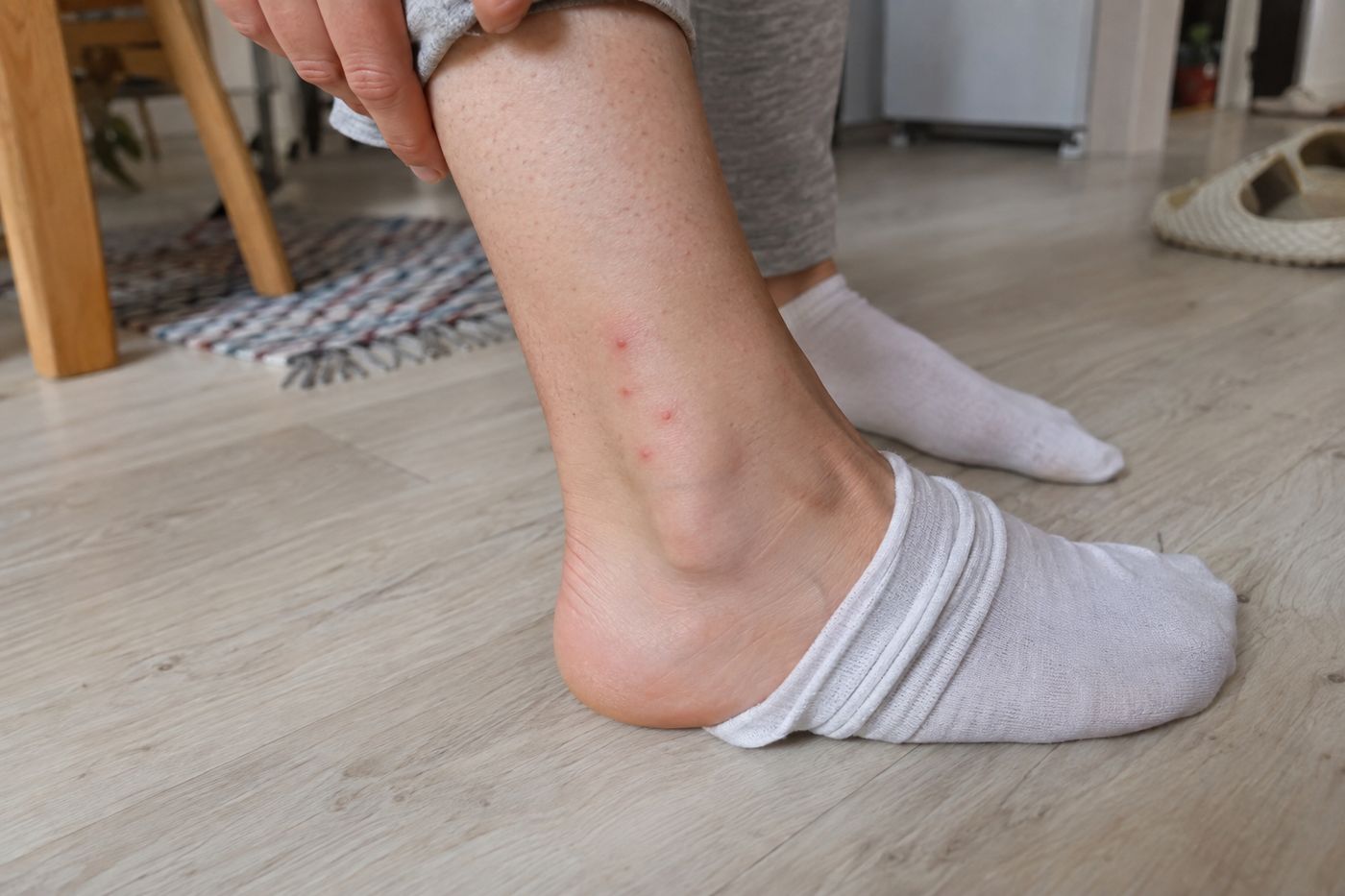 Cluster of small red flea bites with pink halos on a lower leg