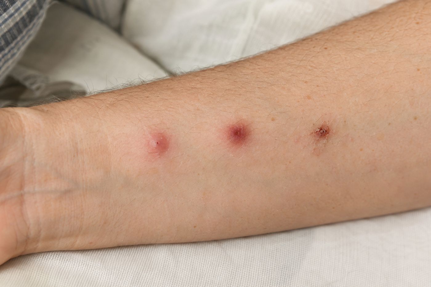 Bed bug bites over time: fresh, on day three, and scratched with a scab
